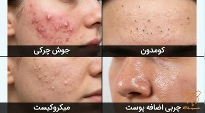 تفاوت جوش چرکی، کومدون، میکروکیست و چربی اضافه پوست | درمان انواع جوش در مشهد