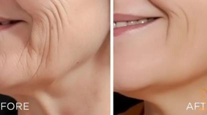 درمان قطعی خطوط آکاردئونی صورت در مشهد | کلینیک شاپرک طلایی