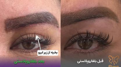 معجزه جوانسازی چشم با بلفاروپلاستی تخصصی