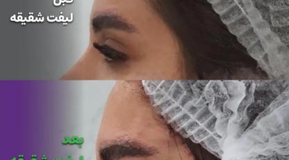 لیفت شقیقه معجزه‌آسا