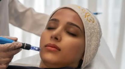 میکرونیدلینگ برای جوانسازی پوست در کلینیک شاپرک طلایی