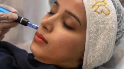 مزونیدلینگ صورت برای جوانسازی و رفع لک و اسکار