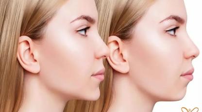 مادلینگ صورت با تزریق ژل زاویه فک