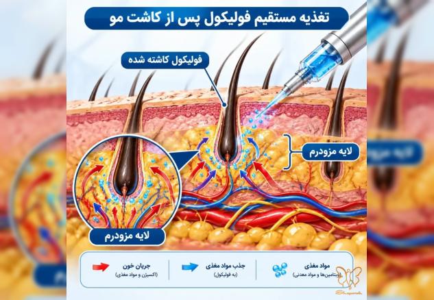 بهترین زمان شروع مزوتراپی و PRP بعد از کاشت مو (جدول زمانی طلایی)
