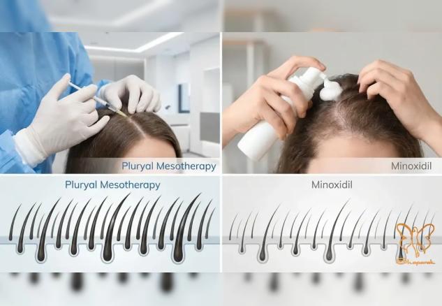 مزو پلوریال سر یا ماینوکسیدیل؟ مقایسه کامل بهترین درمان‌های ریزش مو در مشهد