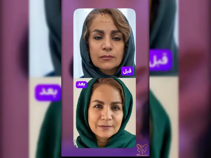 قبل و بعد از تزریق چربی صورت در مشهد