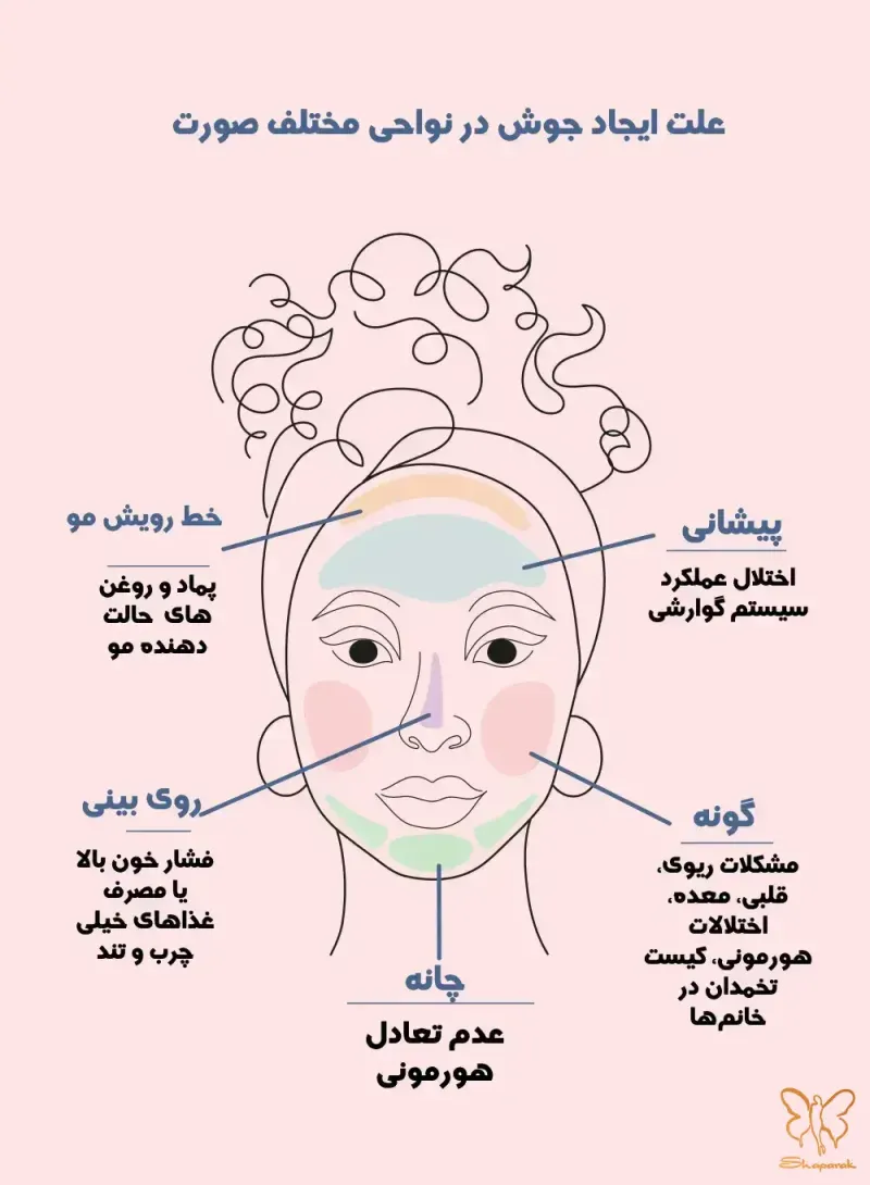 علت زیاد شدن جوش صورت چیست علت زیاد شدن جوش صورت چیست