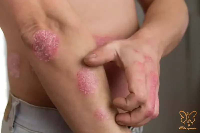 پسوریازیس Psoriasis پسوریازیس Psoriasis