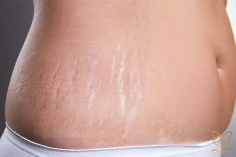 کلینیک شاپرک مشهد ترک های پوستی استریا Striae چیست کلینیک شاپرک مشهد ترک های پوستی استریا Striae چیست
