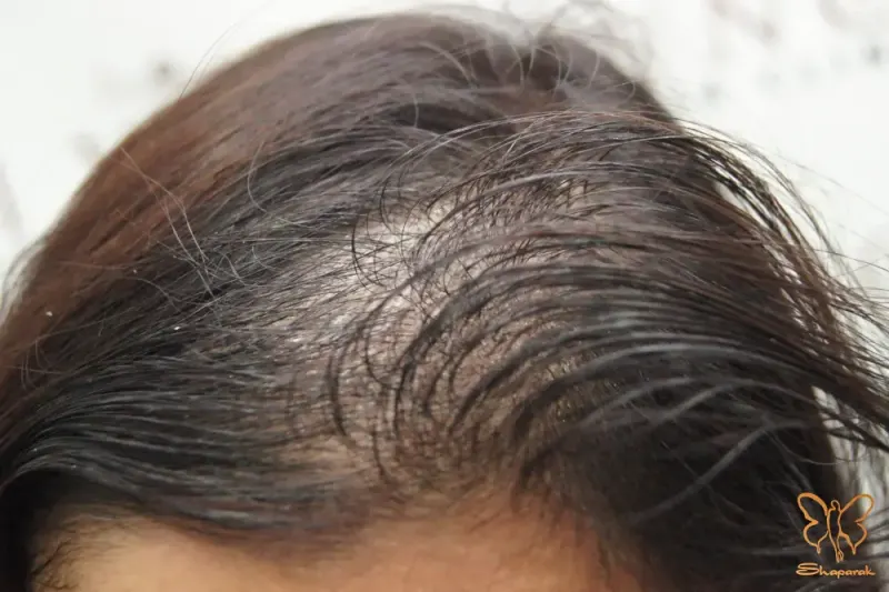 تلوژن افلوویوم ریزش موقتی مو تلوژن افلوویوم ریزش موقتی مو