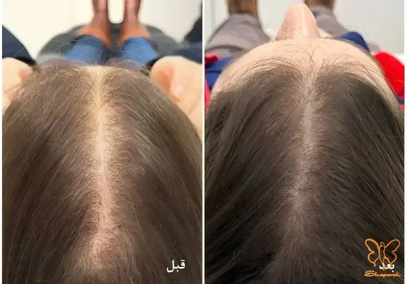 ترمیم و بازسازی بافت پوست سر با PRP در مشهد ترمیم و بازسازی بافت پوست سر با PRP در مشهد