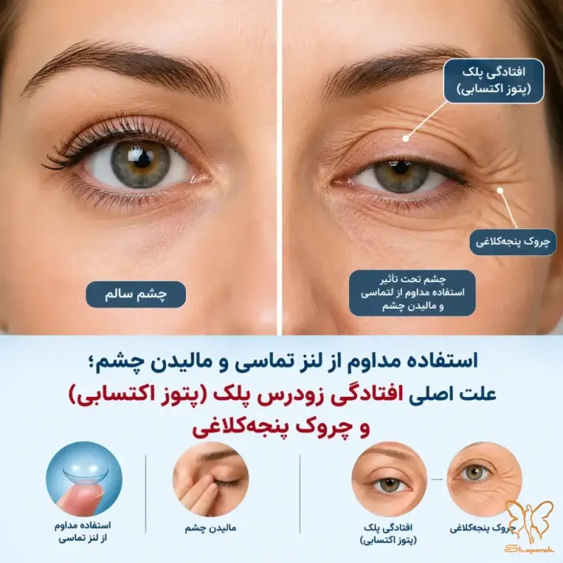 تاثیر روشهای غلط جاگذاری و خروج لنز تماسی بر تاندون پلک