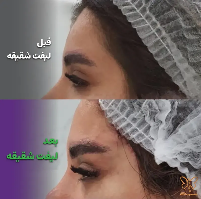تاثیر لیفت شقیقه بر جوانسازی چهره تاثیر لیفت شقیقه بر جوانسازی چهره