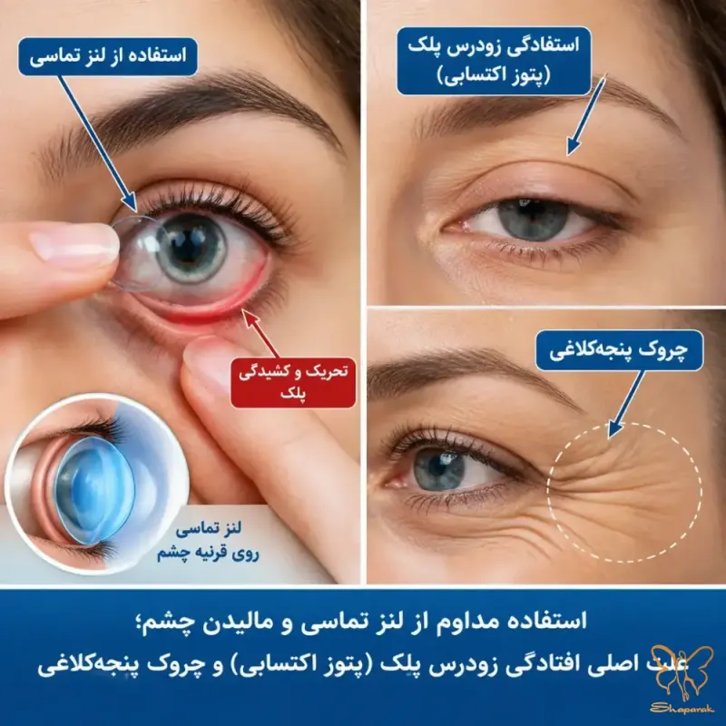 تخریب ماتریکس کلاژن و تشدید هایپرپیگمانتاسیون دور چشم