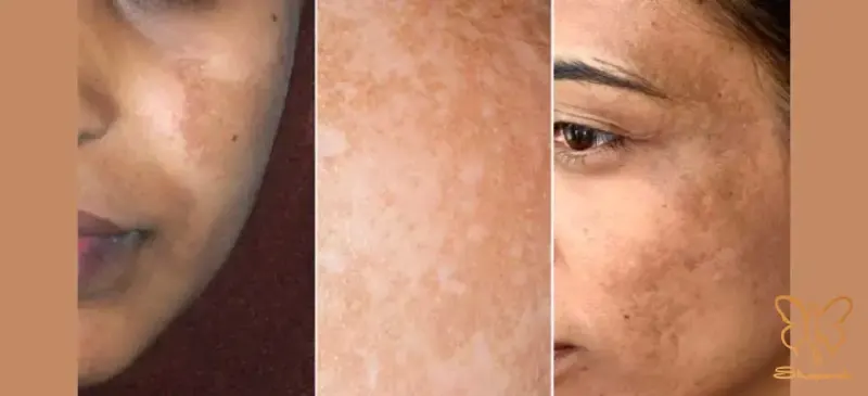 ملاسما Melasma ملاسما Melasma