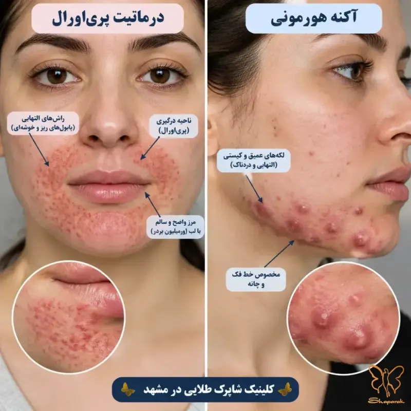 پدیده طغیان مجدد Rebound Effect پس از قطع استروئید