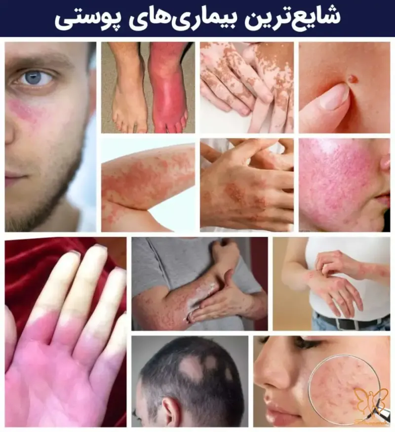 دنیای بیماری های پوستی وسیع و گاهی پیچیده است دنیای بیماری های پوستی وسیع و گاهی پیچیده است
