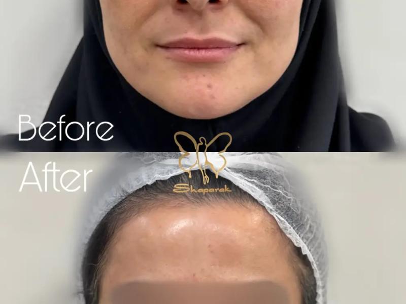 تزریق ژل صورت لیفت و جوانسازی با تکنیک اختصاصی فیس لیفت مایع