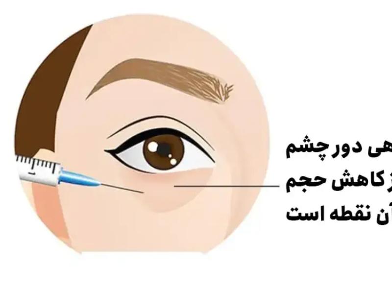 تزریق چربی زیر چشم در مشهد | ماندگارترین روش رفع گودی و سیاهی چشم