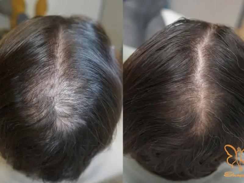 درمان قطعی ریزش مو و چروک عمیق با تزریق PRP VIP Plus 