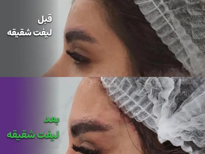 لیفت شقیقه معجزه‌آسا