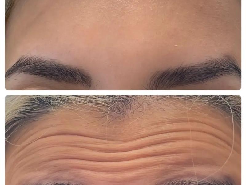  تزریق بوتاکس صورت و خداحافظی با چین و چروک صورت