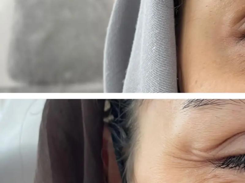  تزریق بوتاکس صورت و خداحافظی با چین و چروک صورت