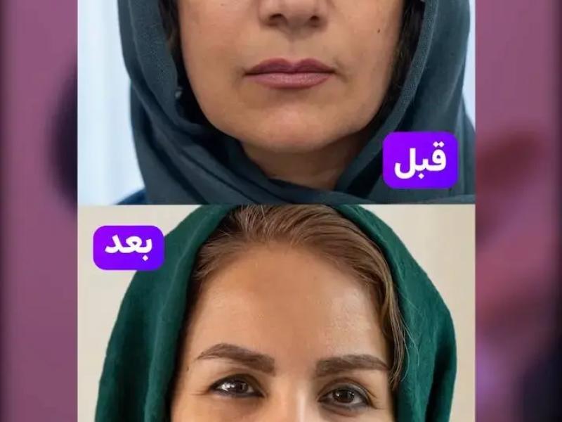  راز جوانی همیشگی و طبیعی با تزریق چربی