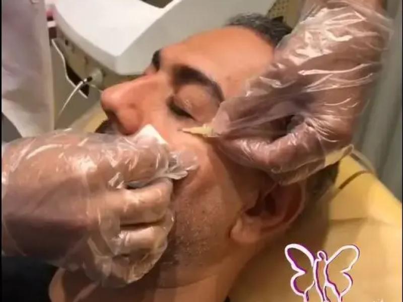کربوکسی تراپی چیست و چه کاربردی دارد؟ راهنمای کامل + نتایج و قیمت