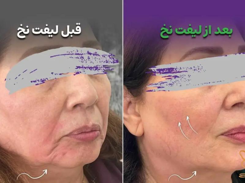 لیفت نخ سیلوئت آمریکایی راز جوانی ماندگار و طبیعی