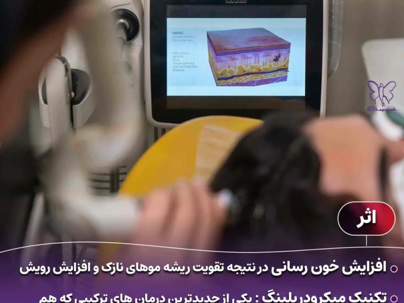 فوتونا میکرودرلینگ سر: جدیدترین درمان ریزش مو بدون درد