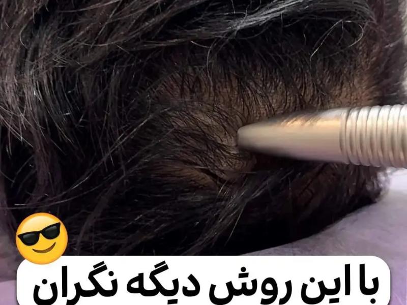 فوتونا میکرودرلینگ سر: جدیدترین درمان ریزش مو بدون درد