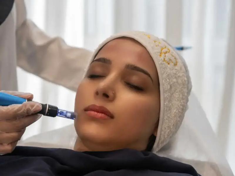 میکرونیدلینگ برای جوانسازی پوست در کلینیک شاپرک طلایی
