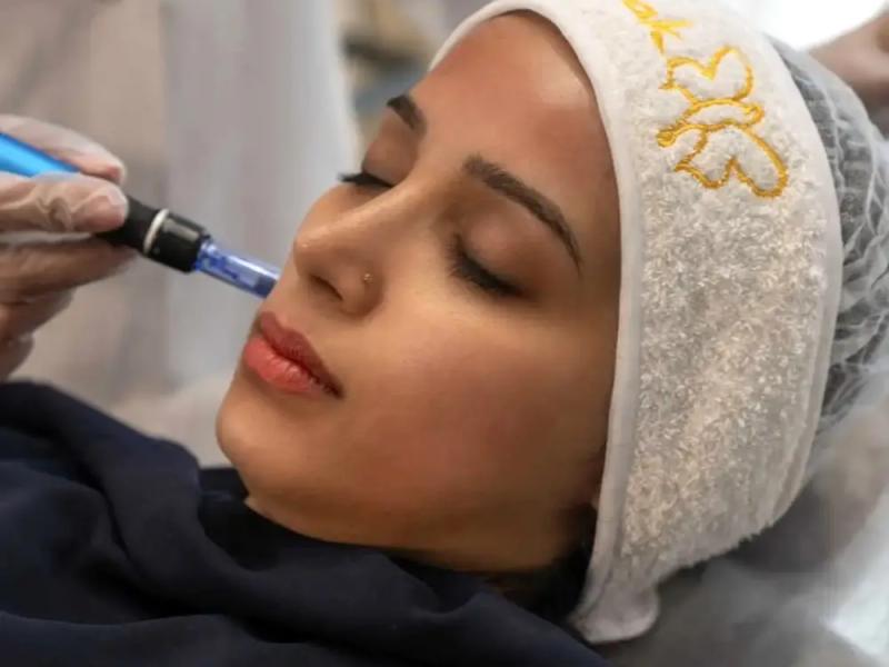 مزونیدلینگ صورت برای جوانسازی و رفع لک و اسکار