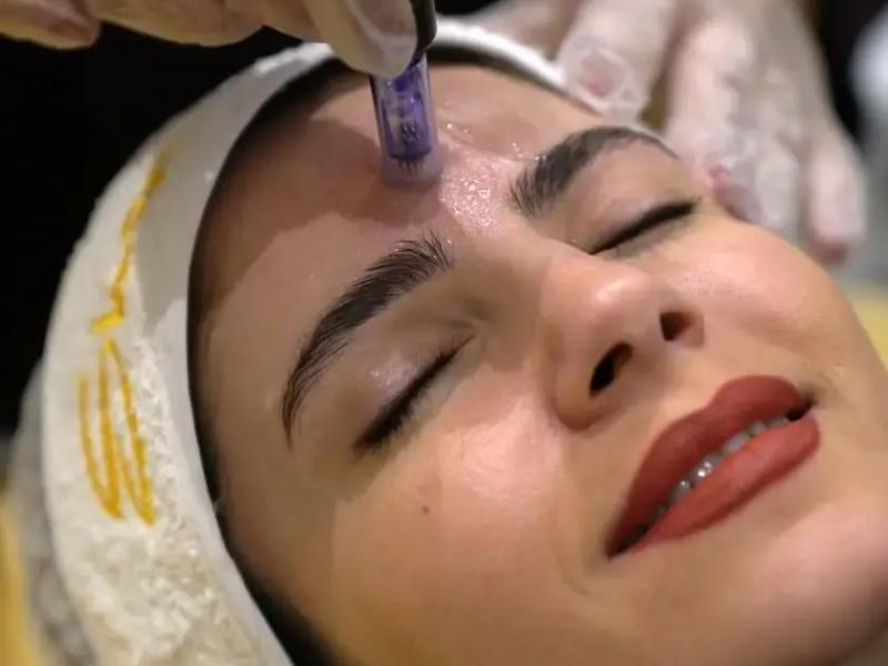 میکرونیدلینگ برای جوانسازی پوست در کلینیک شاپرک طلایی