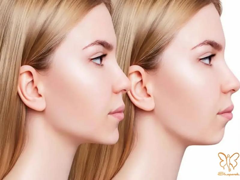 مادلینگ صورت با تزریق ژل زاویه فک