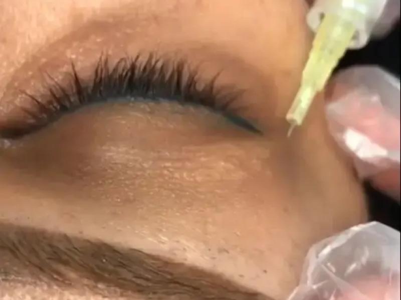 کربوکسی تراپی چیست و چه کاربردی دارد؟ راهنمای کامل + نتایج و قیمت
