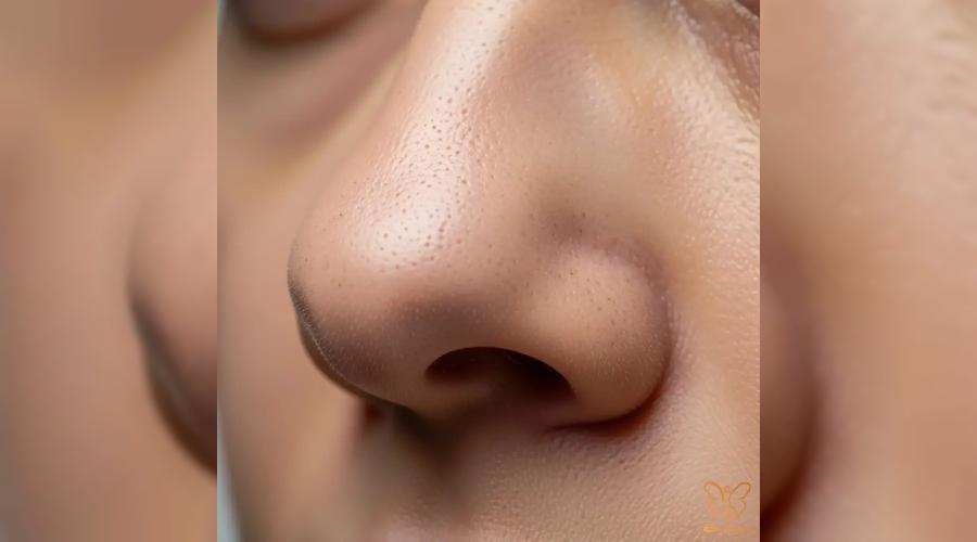 از جوش سر سفید تا آکنه کیستیک؛ با این روش‌ها برای همیشه از شر جوش خلاص شوید!