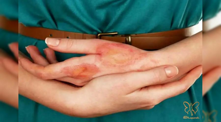 اسکلرودرمی و زیبایی: کدام خدمات (بوتاکس، ژل، لیزر) ممنوع و کدام مجاز است؟