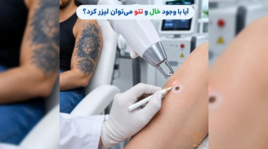 آیا لیزر روی تتو و خال ممنوع است؟ | رازهای طلایی در بهترین کلینیک لیزر مشهد!