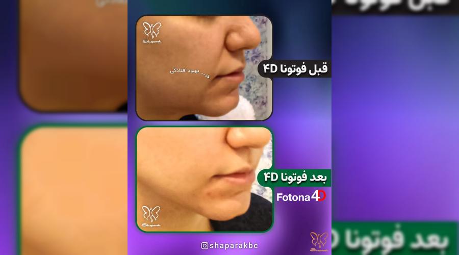جوانسازی پوست با لیزر فوتونا فوردی: نه یک درمان، بلکه یک تولد دوباره!